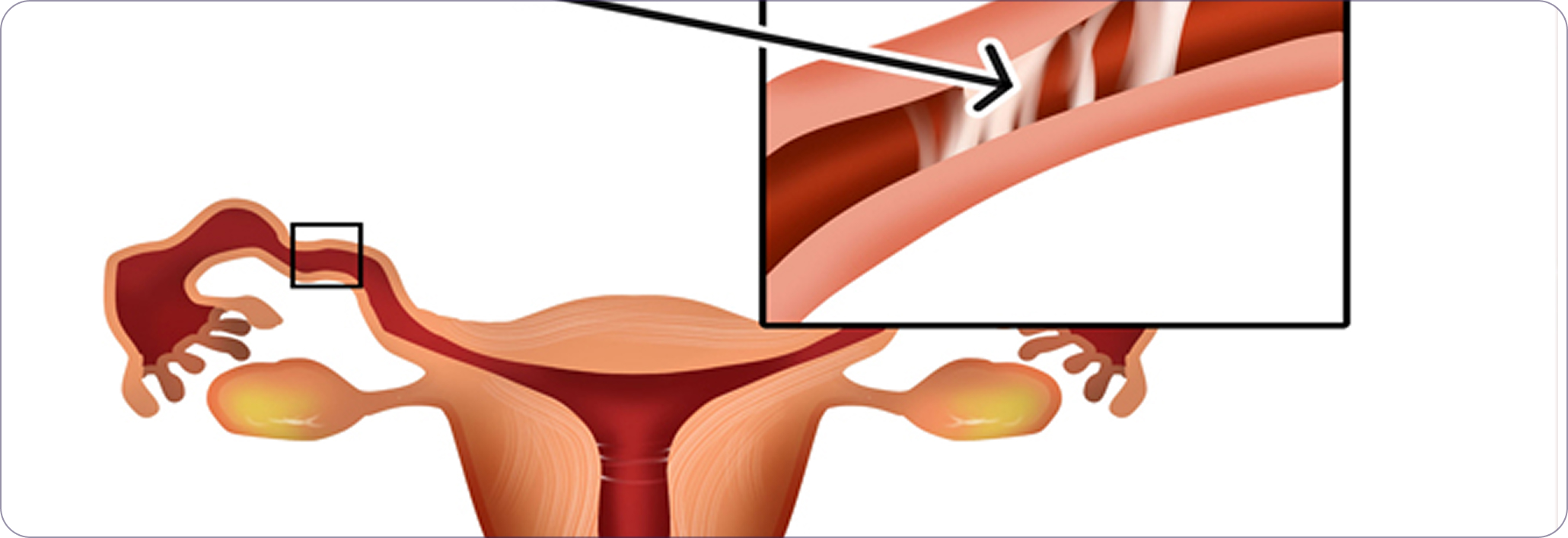 Step 3: Guided imaging to confirm blockage
