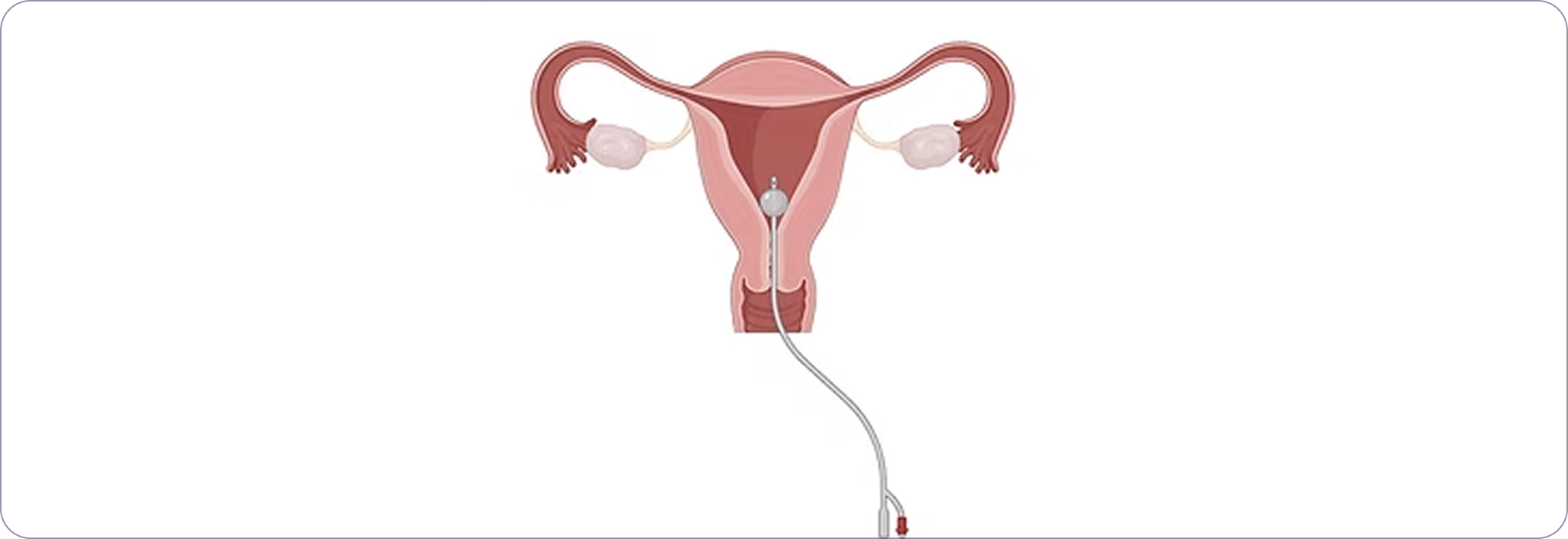Step 4: Recanalization of occluded tube