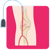 Genicular Artery Embolization