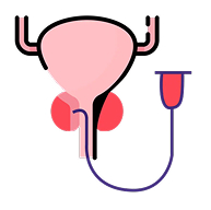 Prostate Artery Embolization