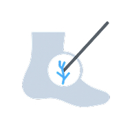 Plantar Fascial Embolization