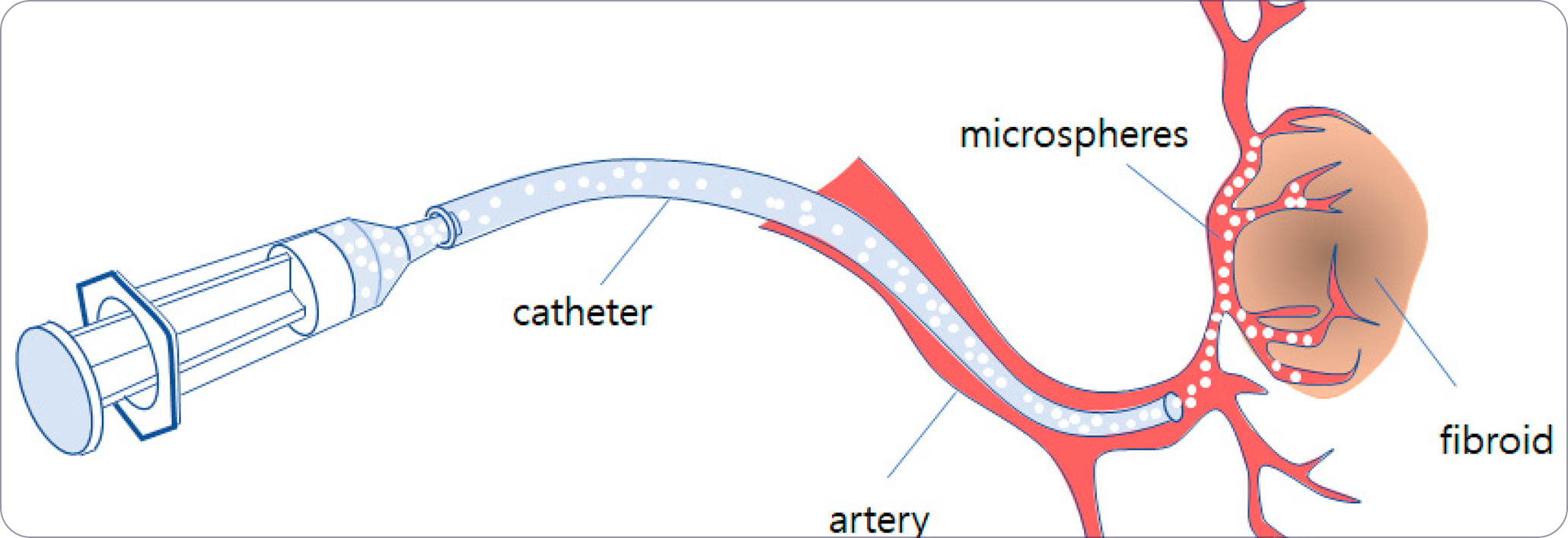 Microparticle injection
