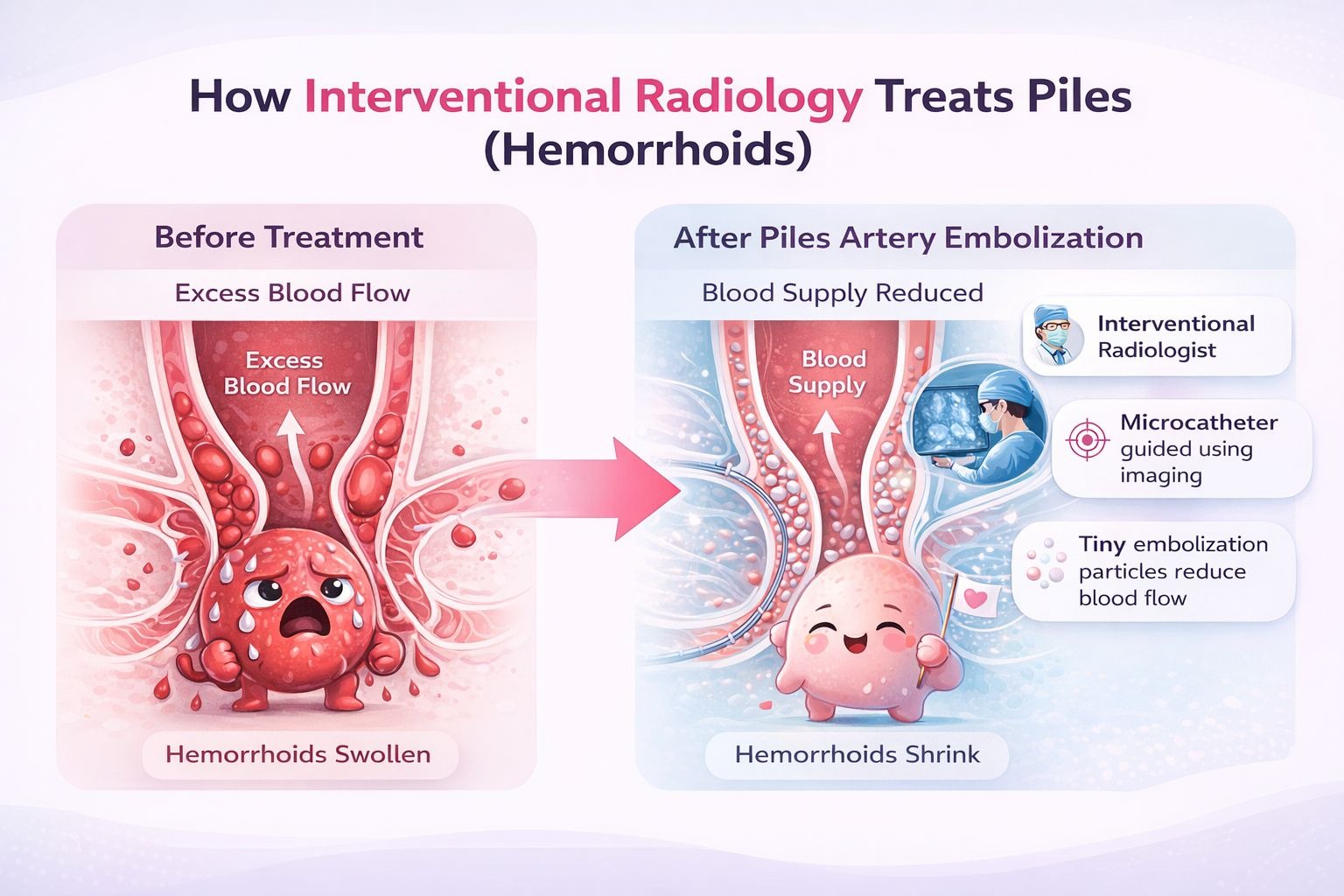 What happens in rectal artery embolization