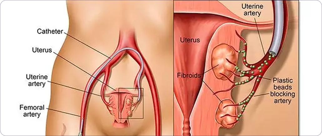 Step 2: Access via wrist or groin