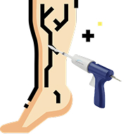 Venous Glue Closure icon