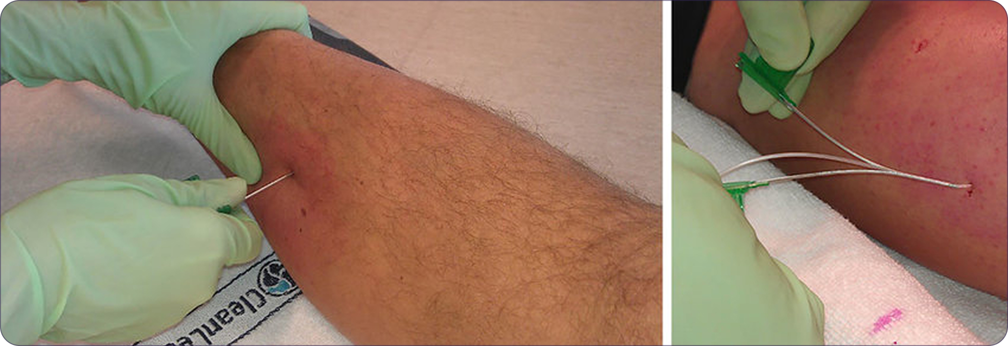 Access via small skin puncture