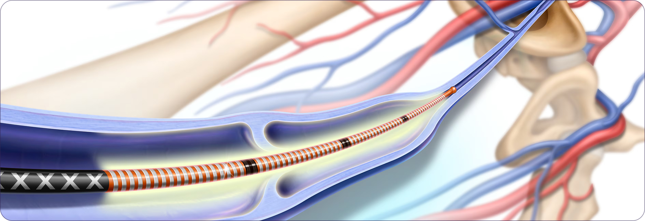 Guided ablation using heat or adhesive